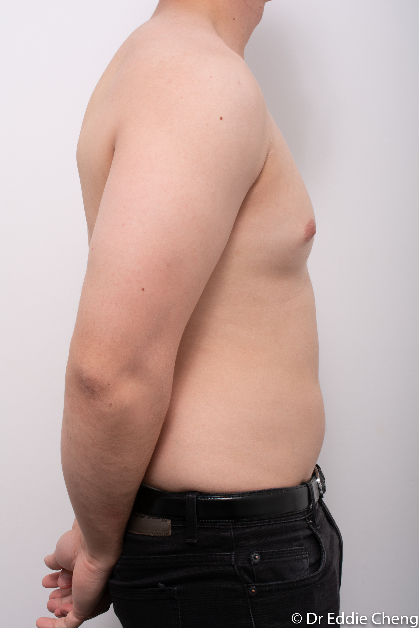 gynaecomastia dr eddie cheng brisbane pre and post op -1