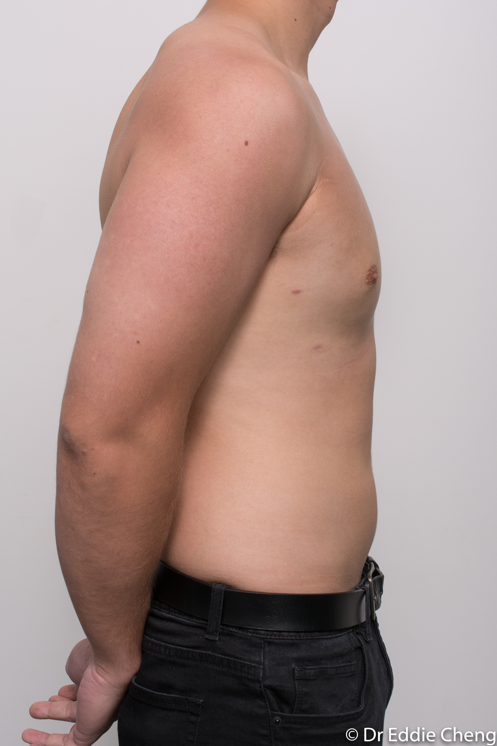 gynaecomastia dr eddie cheng brisbane pre and post op -10