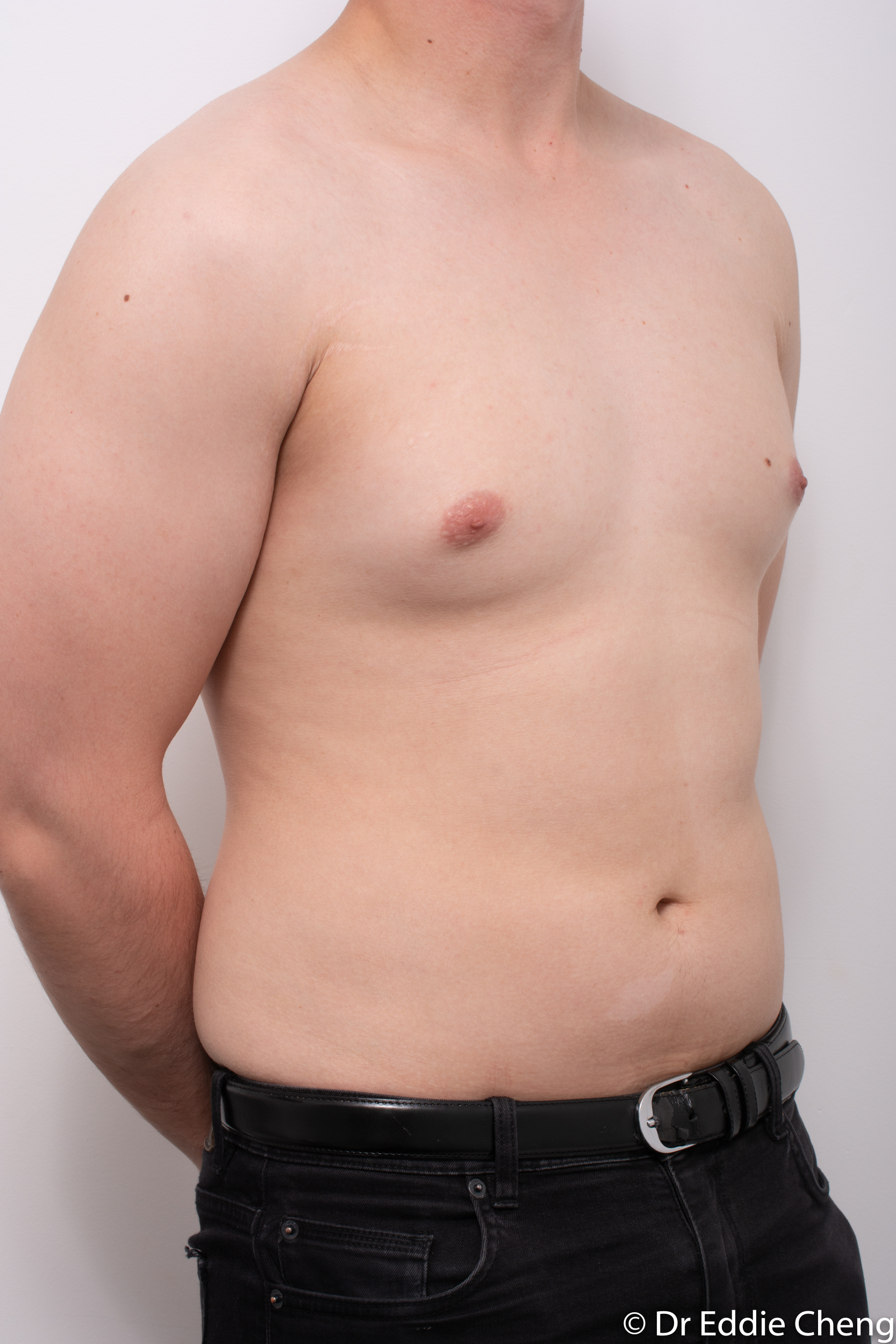 gynaecomastia dr eddie cheng brisbane pre and post op -2