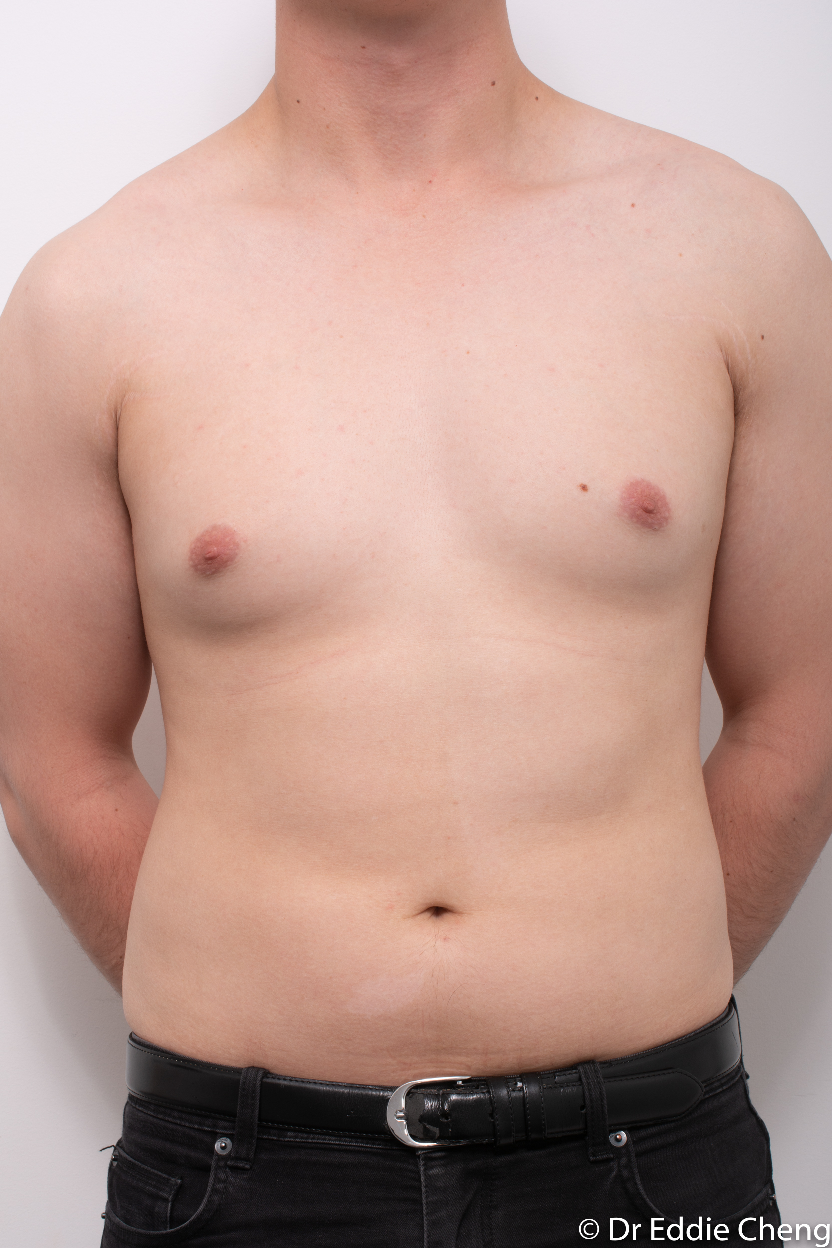 gynaecomastia dr eddie cheng brisbane pre and post op -3