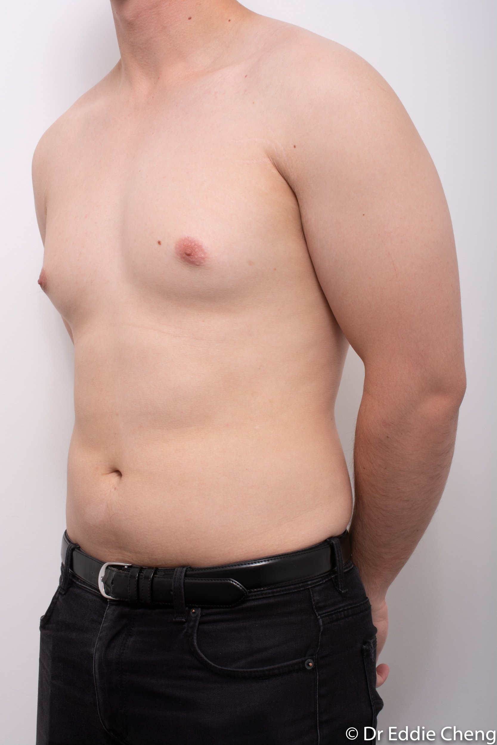 gynaecomastia dr eddie cheng brisbane pre and post op -4