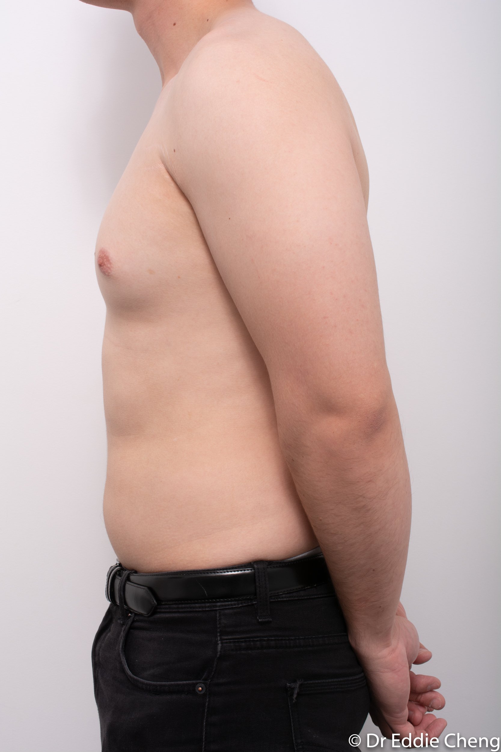 gynaecomastia dr eddie cheng brisbane pre and post op -5