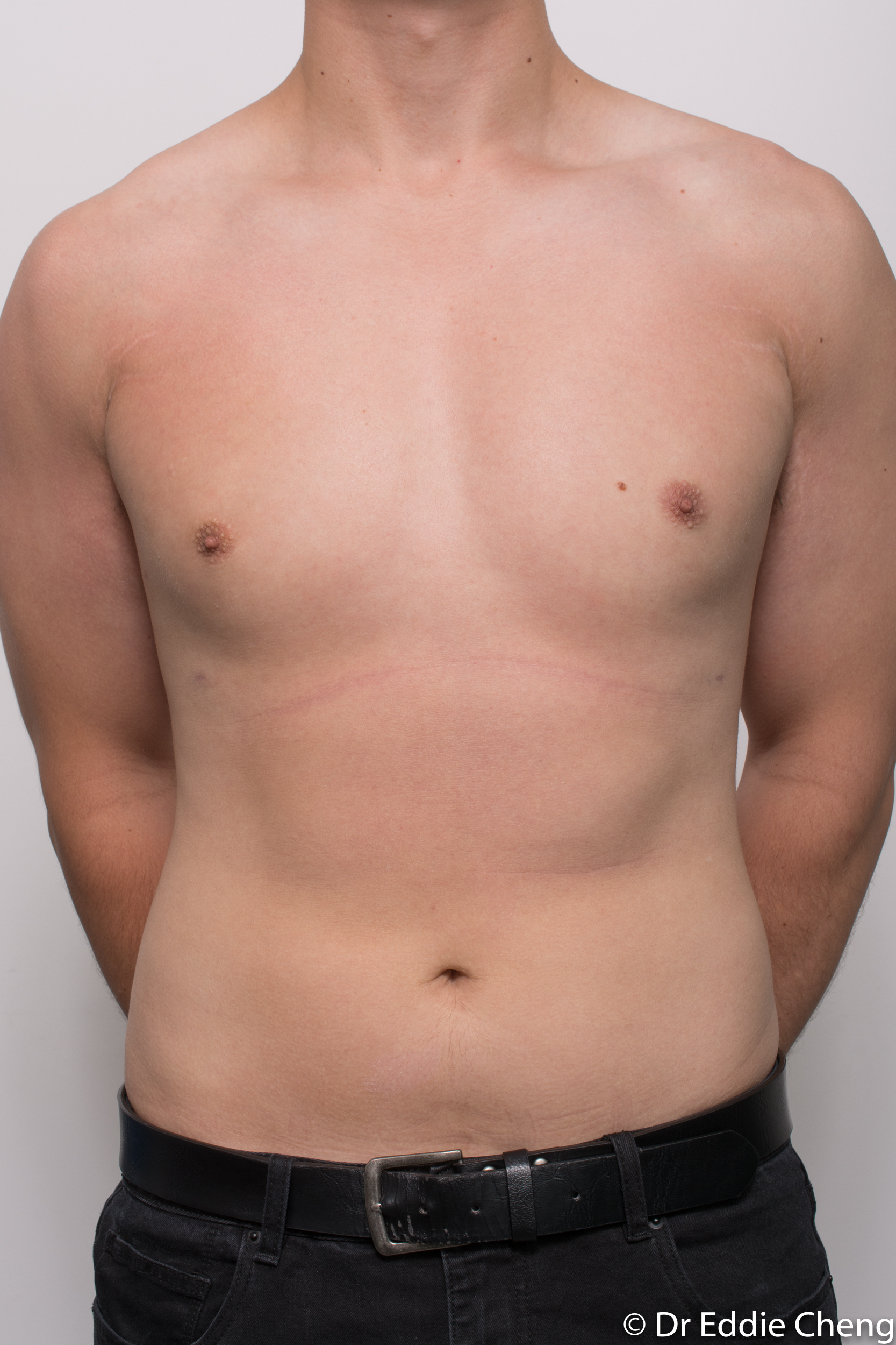 gynaecomastia dr eddie cheng brisbane pre and post op -6