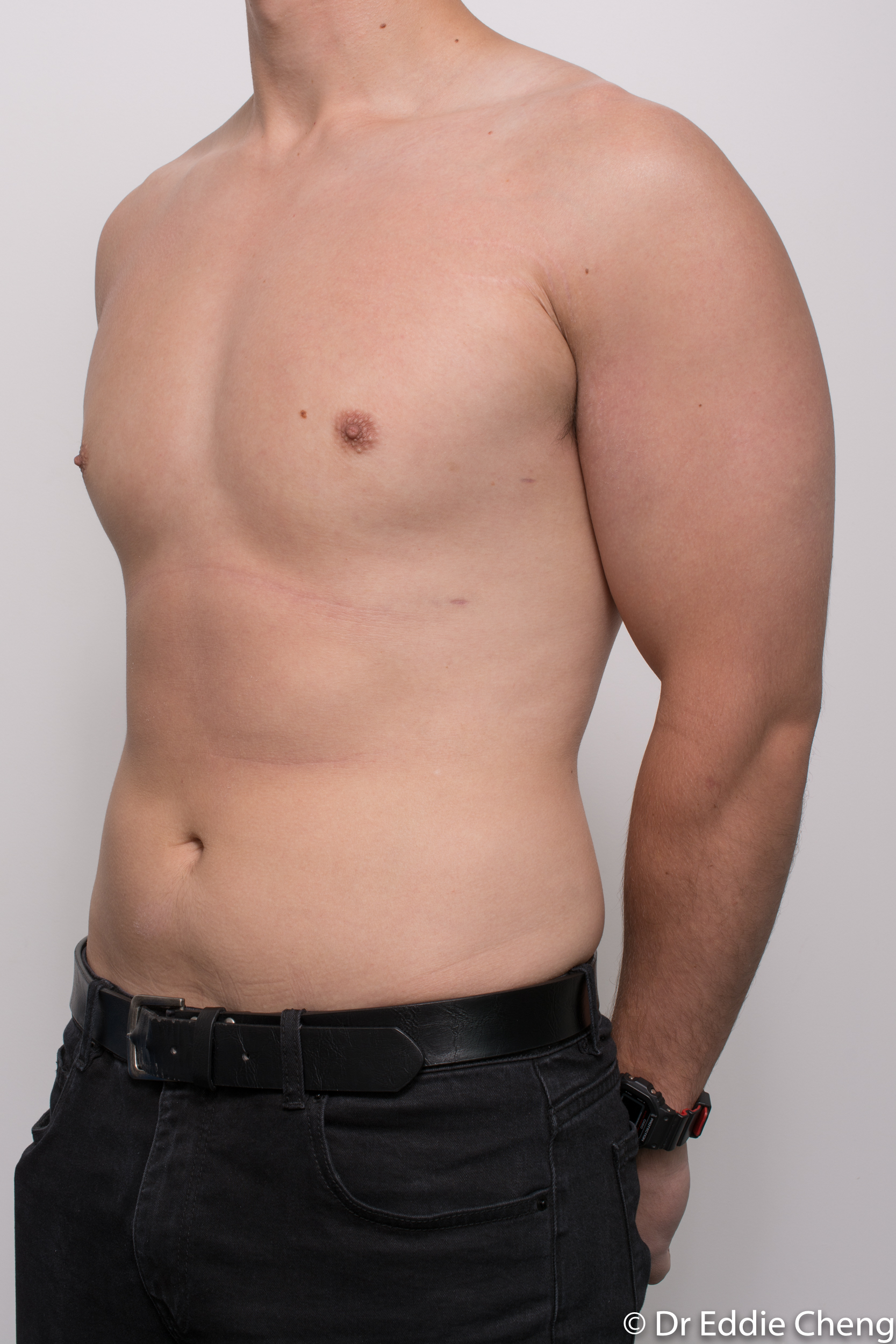 gynaecomastia dr eddie cheng brisbane pre and post op -7