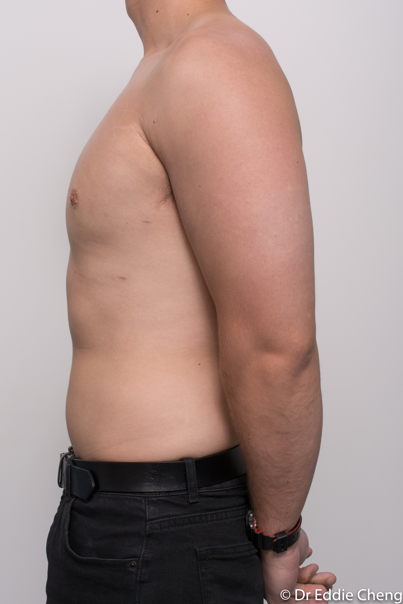 gynaecomastia dr eddie cheng brisbane pre and post op -8