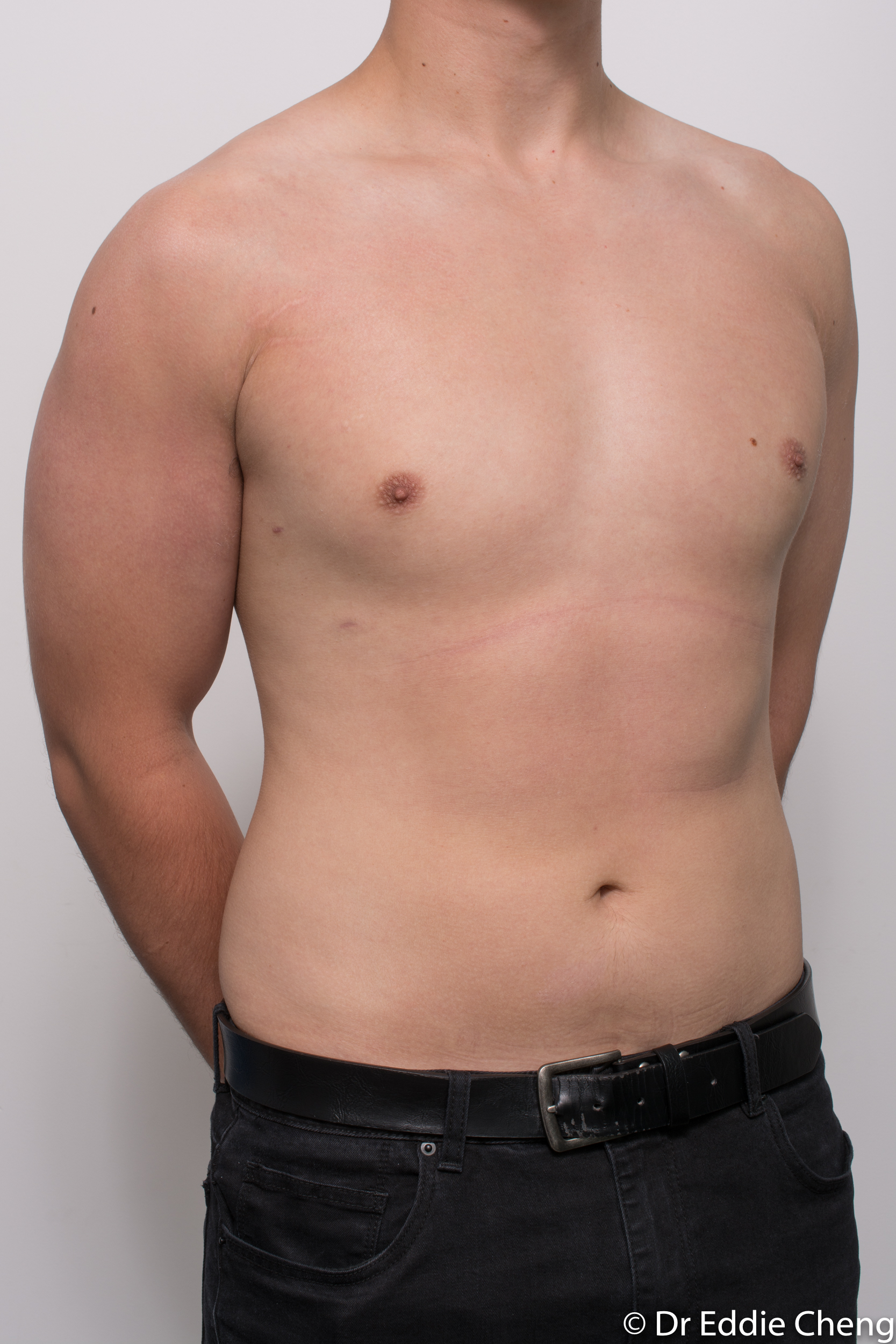 gynaecomastia dr eddie cheng brisbane pre and post op -9