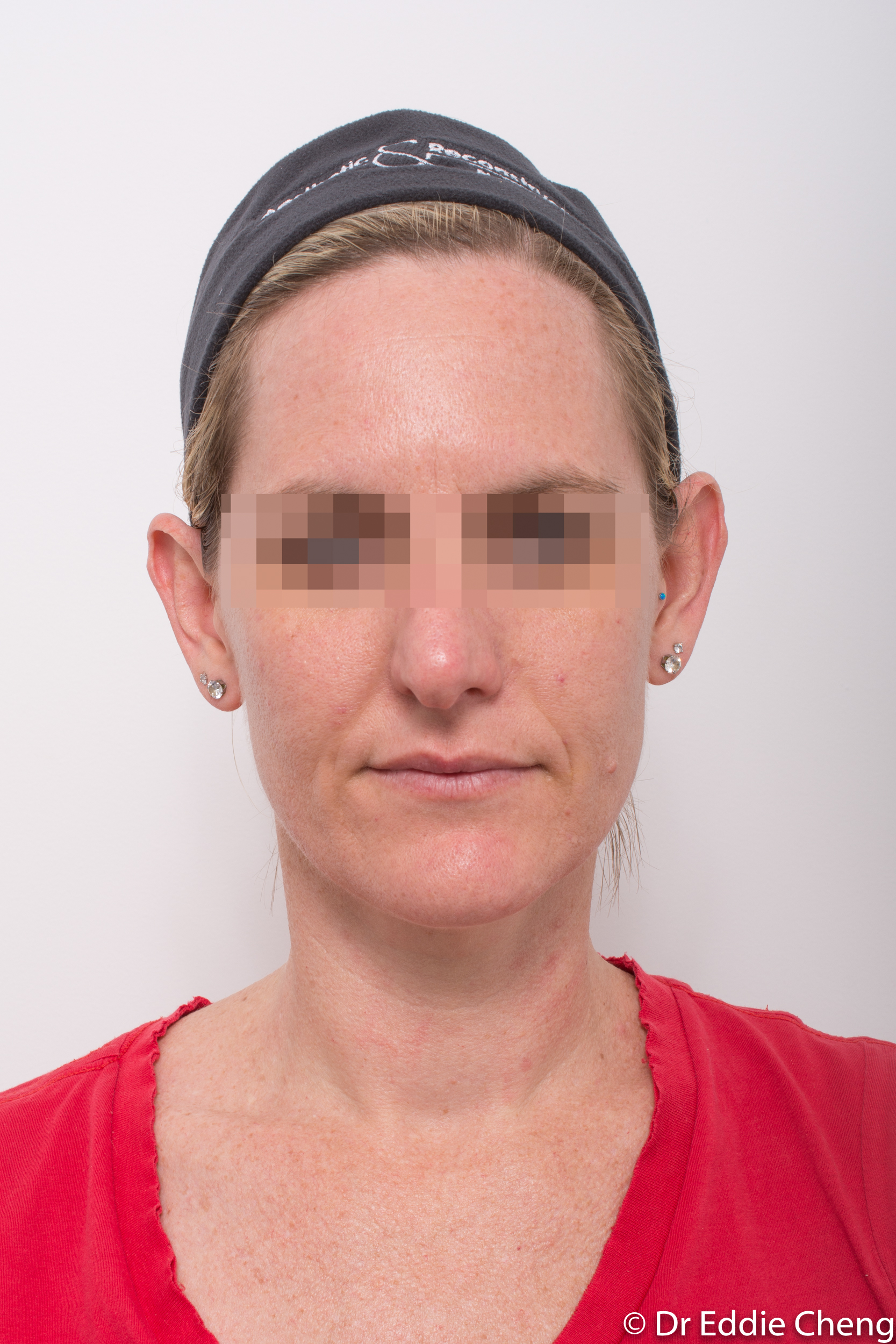 otoplasty dr eddie cheng brisbane-3