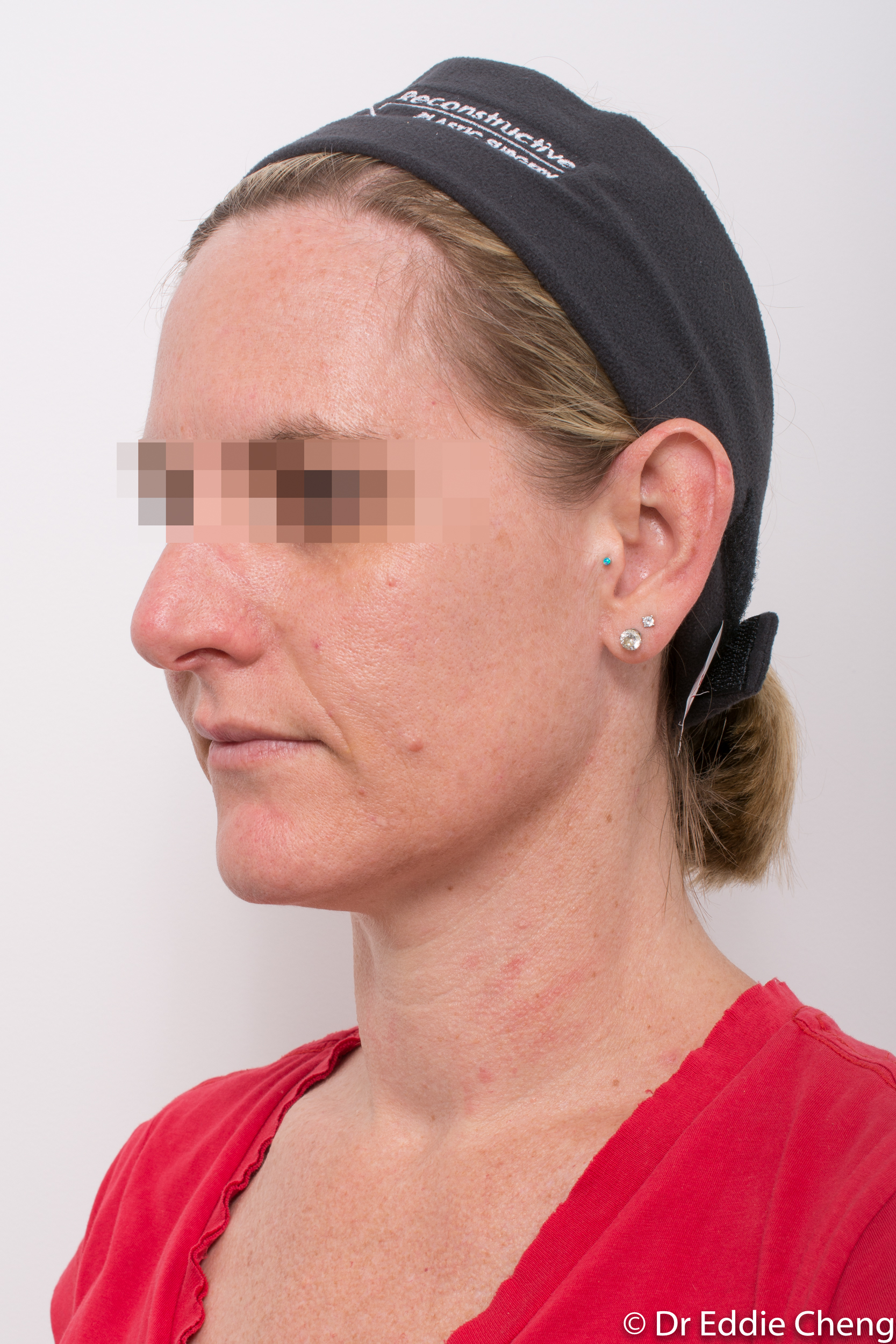 otoplasty dr eddie cheng brisbane-4