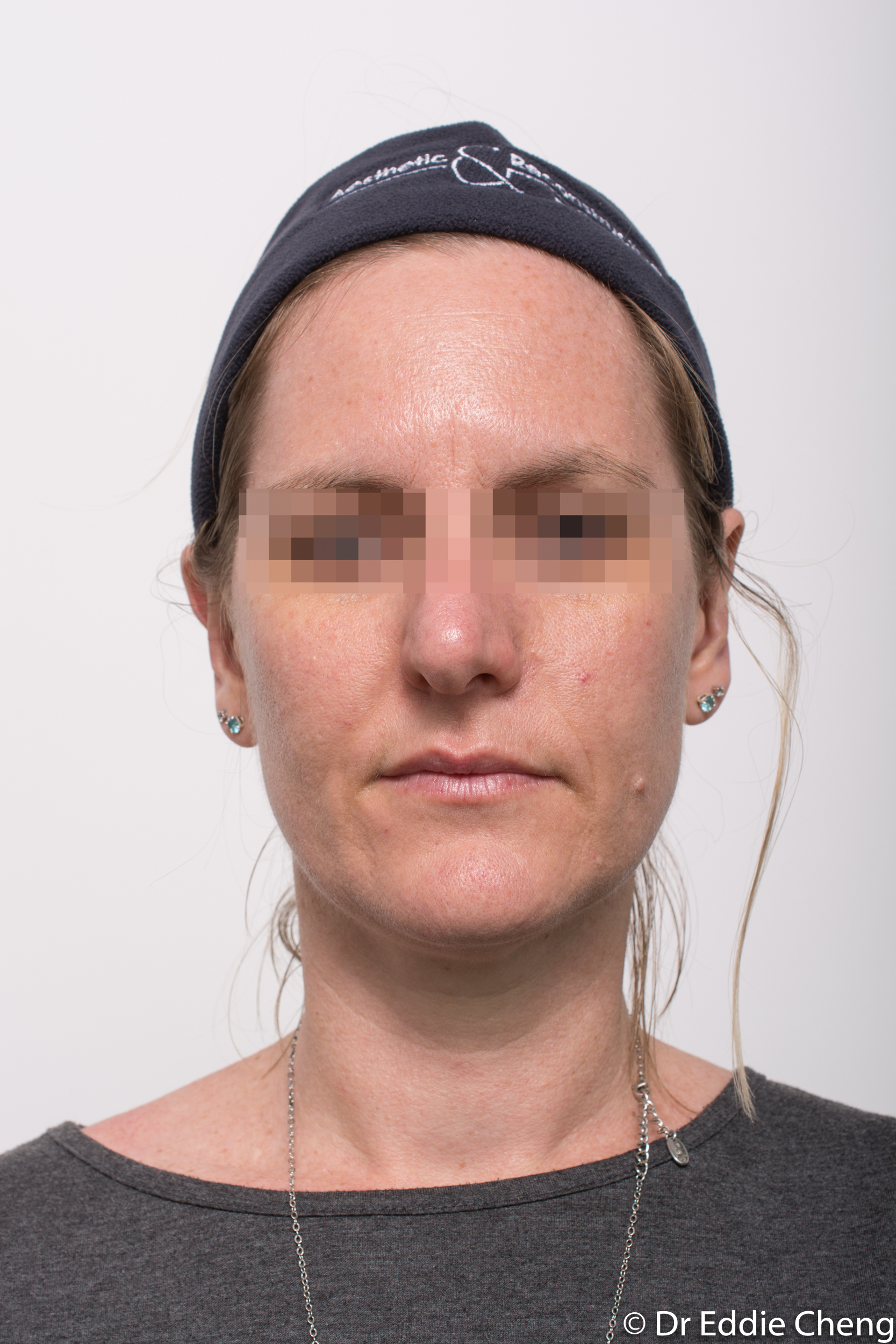 otoplasty dr eddie cheng brisbane-6