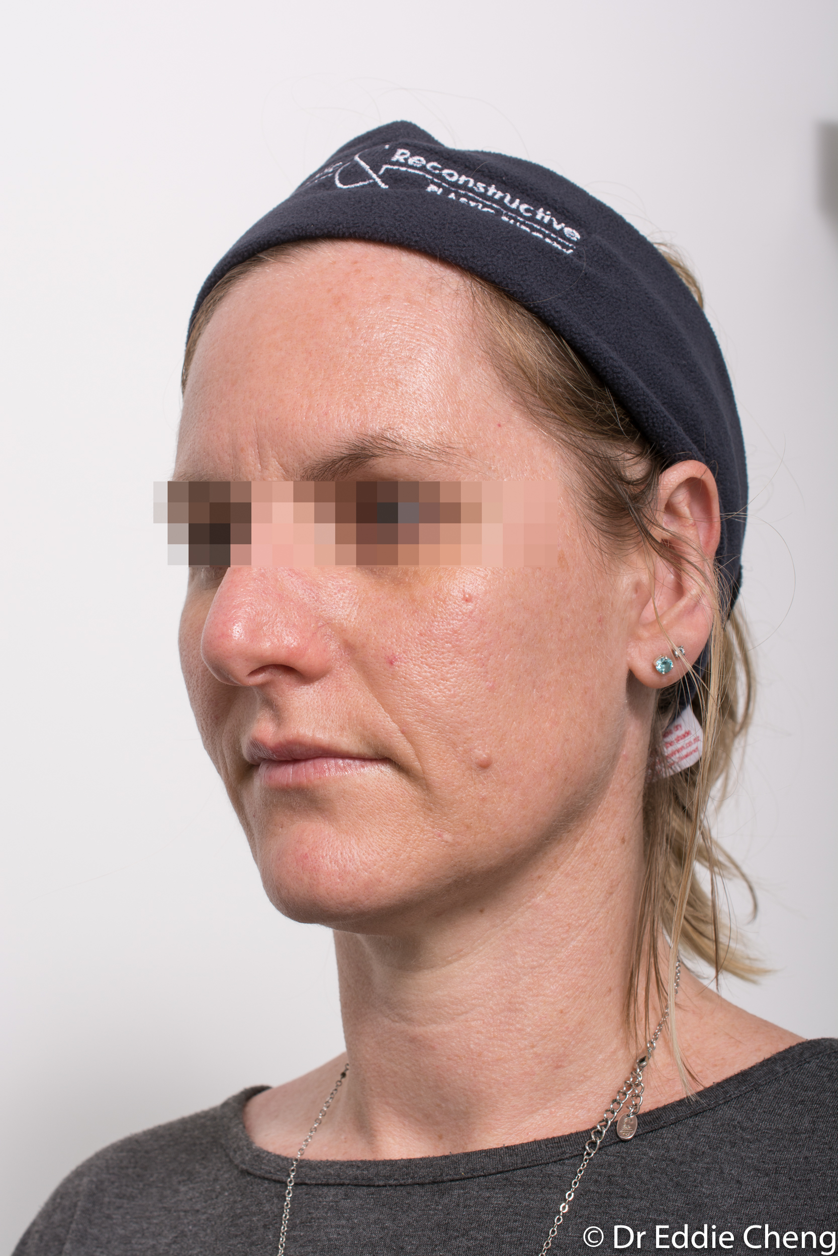 otoplasty dr eddie cheng brisbane-7