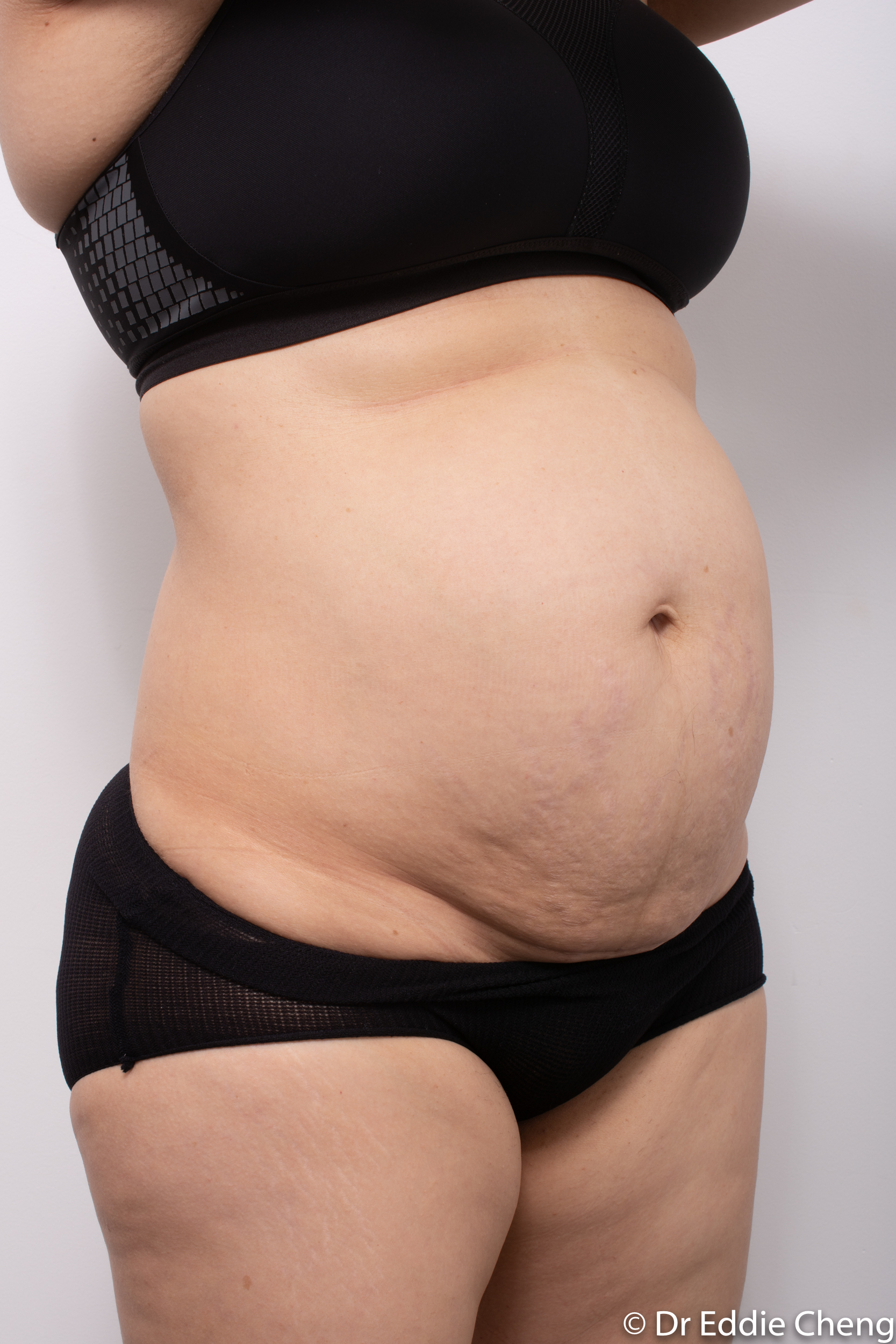 post abdominoplasty dr eddie cheng brisbane-2