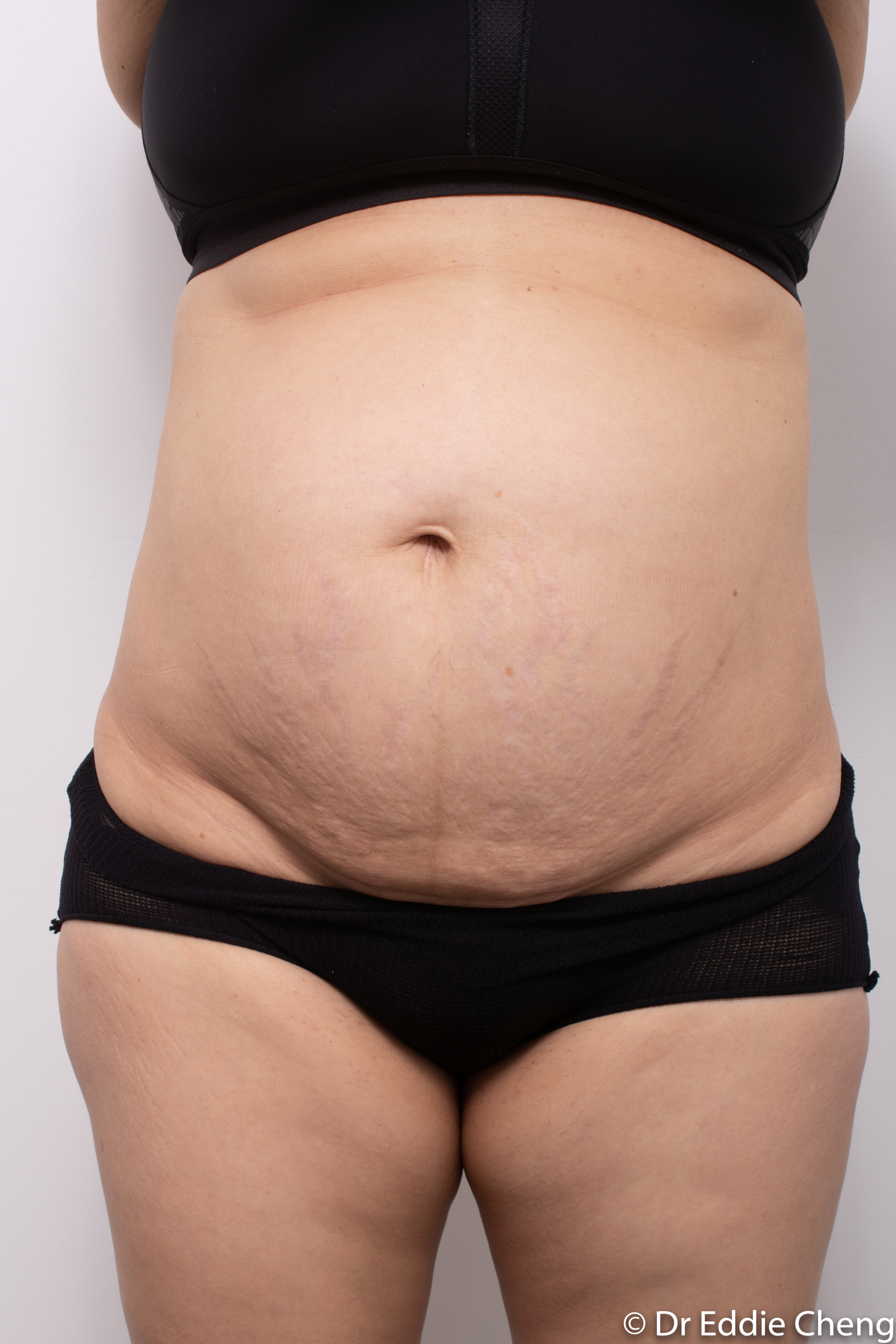 post abdominoplasty dr eddie cheng brisbane-3