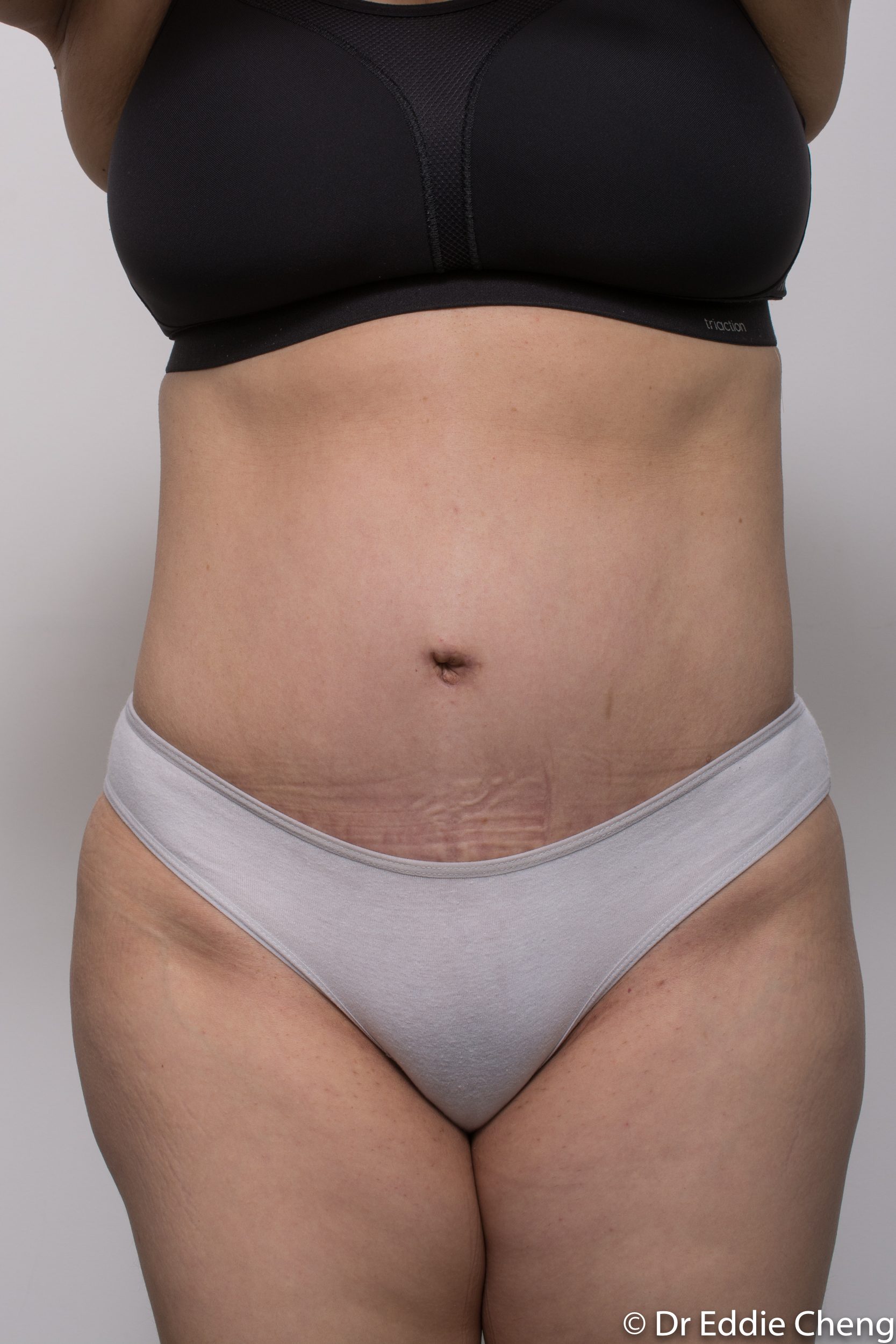 post abdominoplasty dr eddie cheng brisbane-4