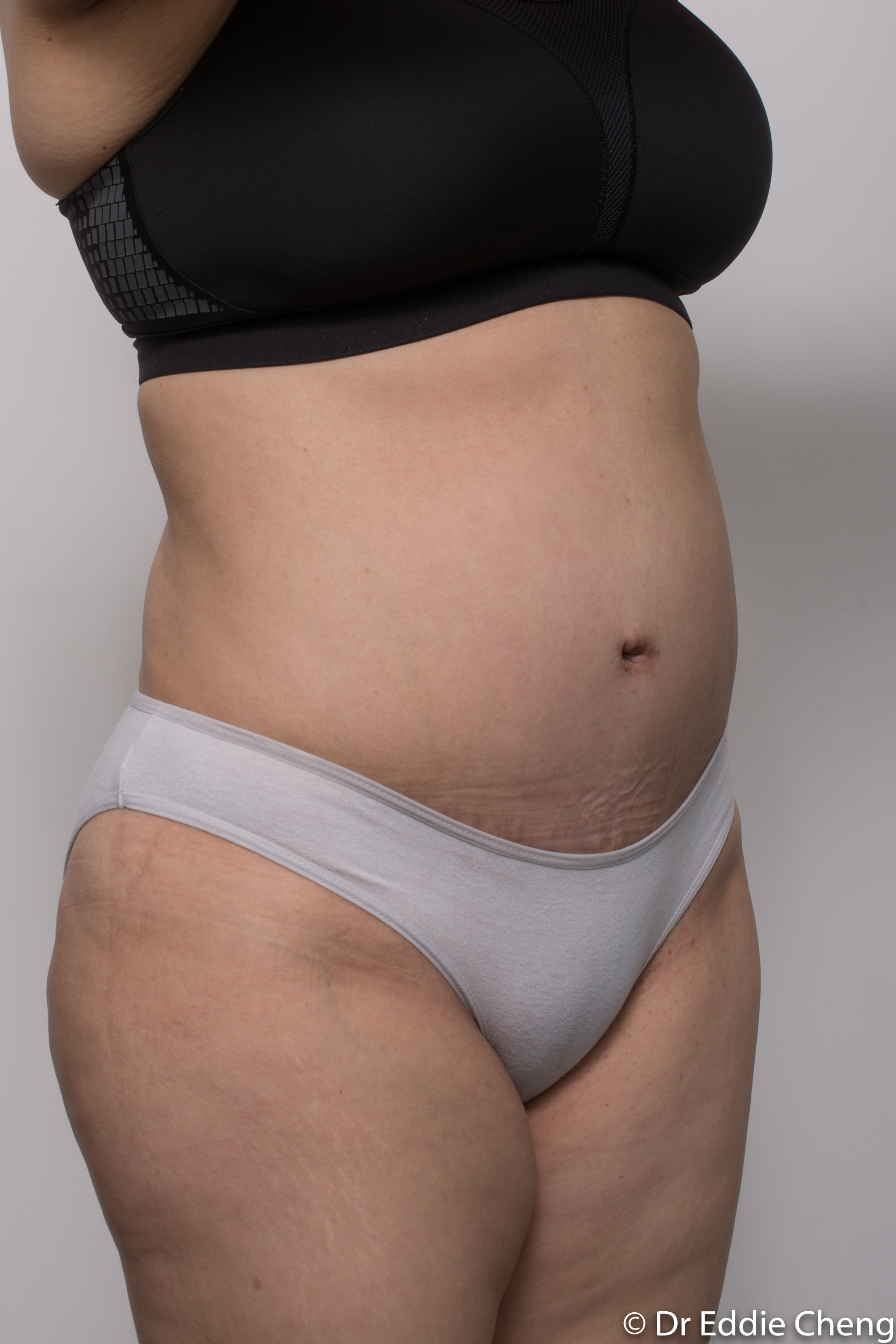 post abdominoplasty dr eddie cheng brisbane-5