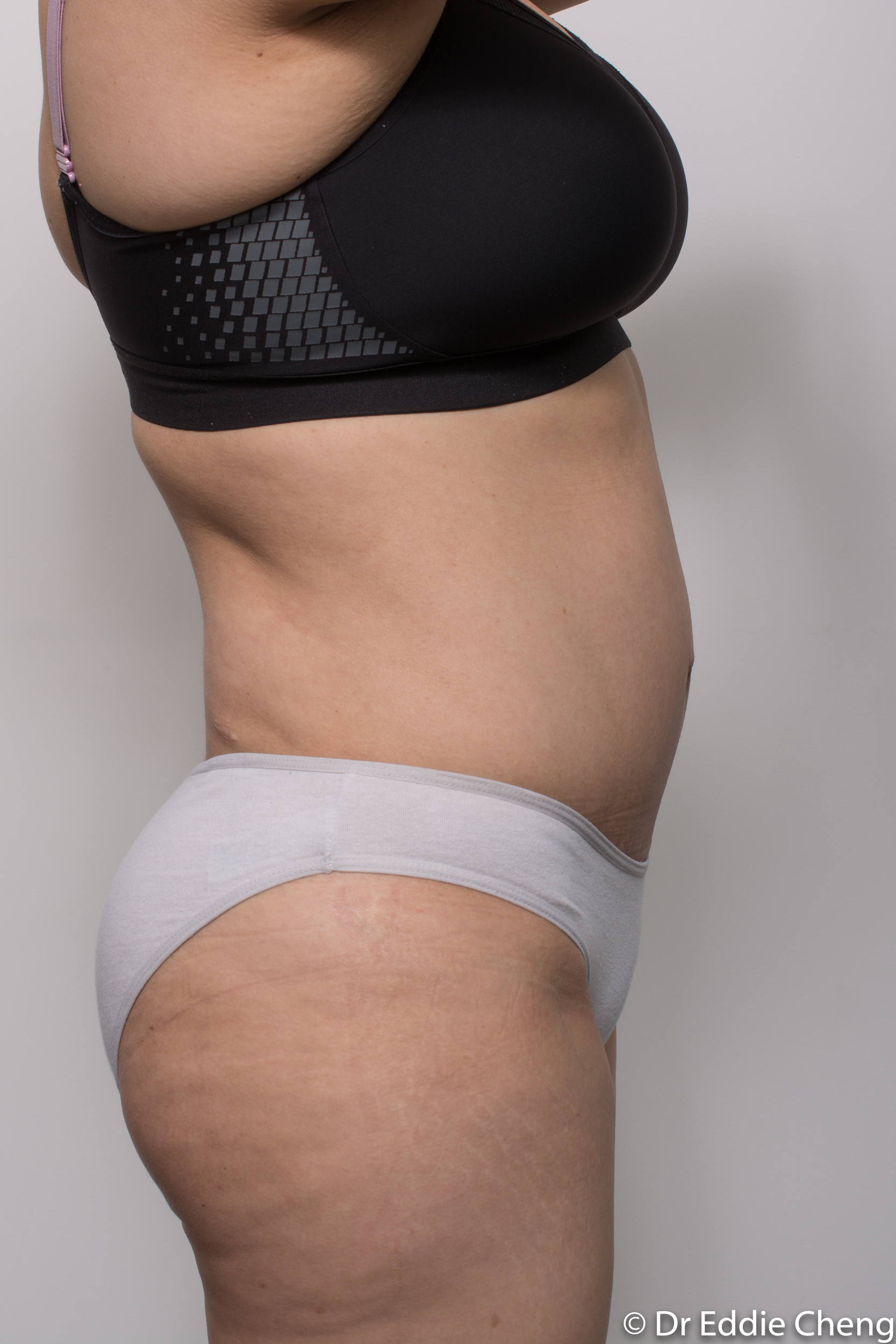 post abdominoplasty dr eddie cheng brisbane-6