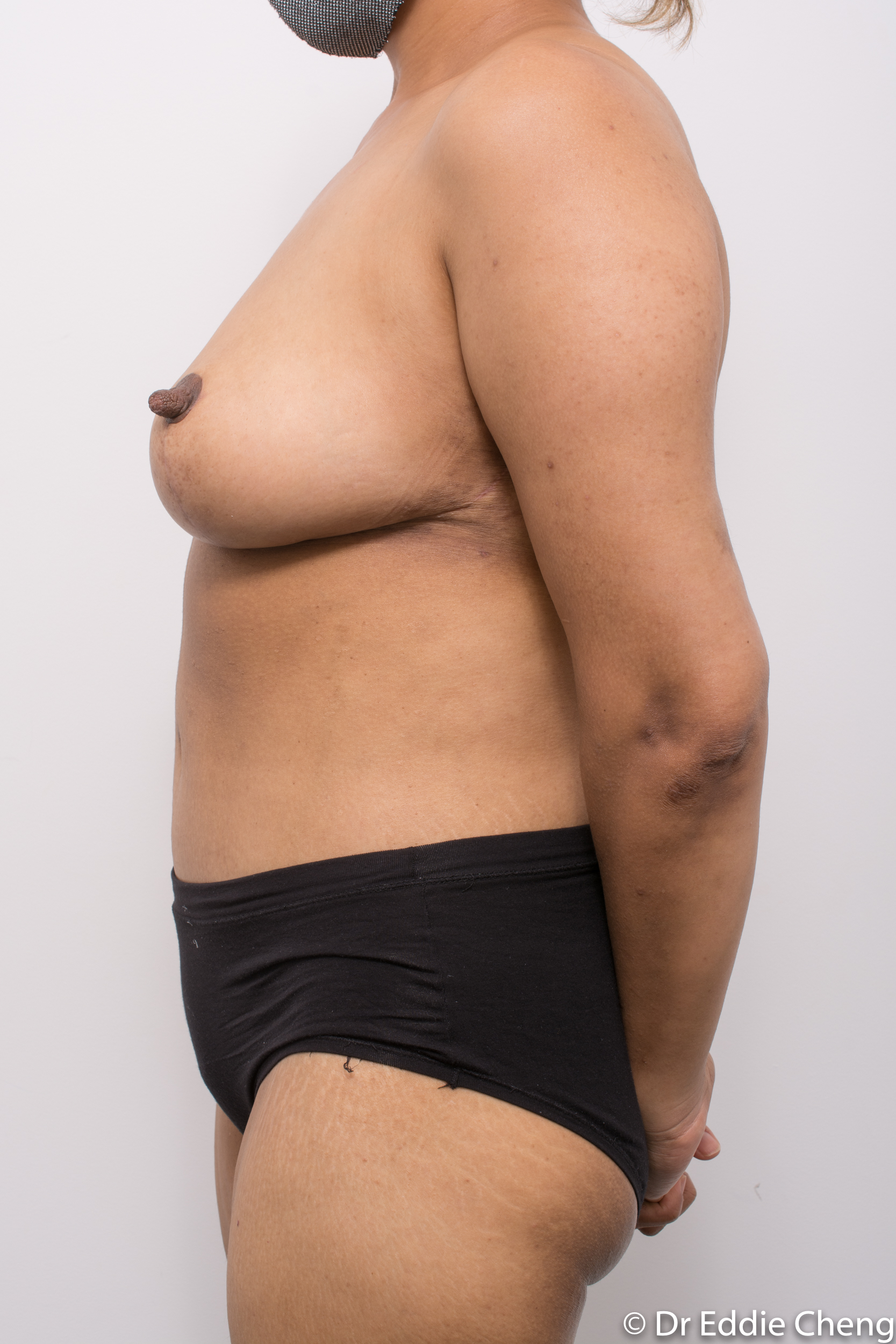 post op breast reduction & chest wall lipecomy-5