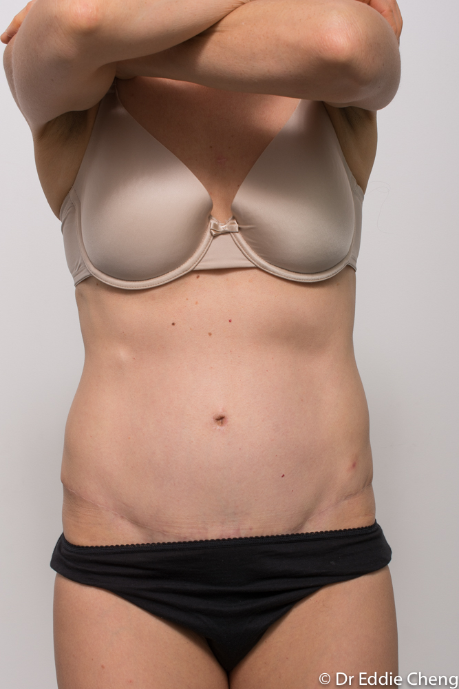 Cosmetic Surgery Tummy Tuck Before and After Gallery