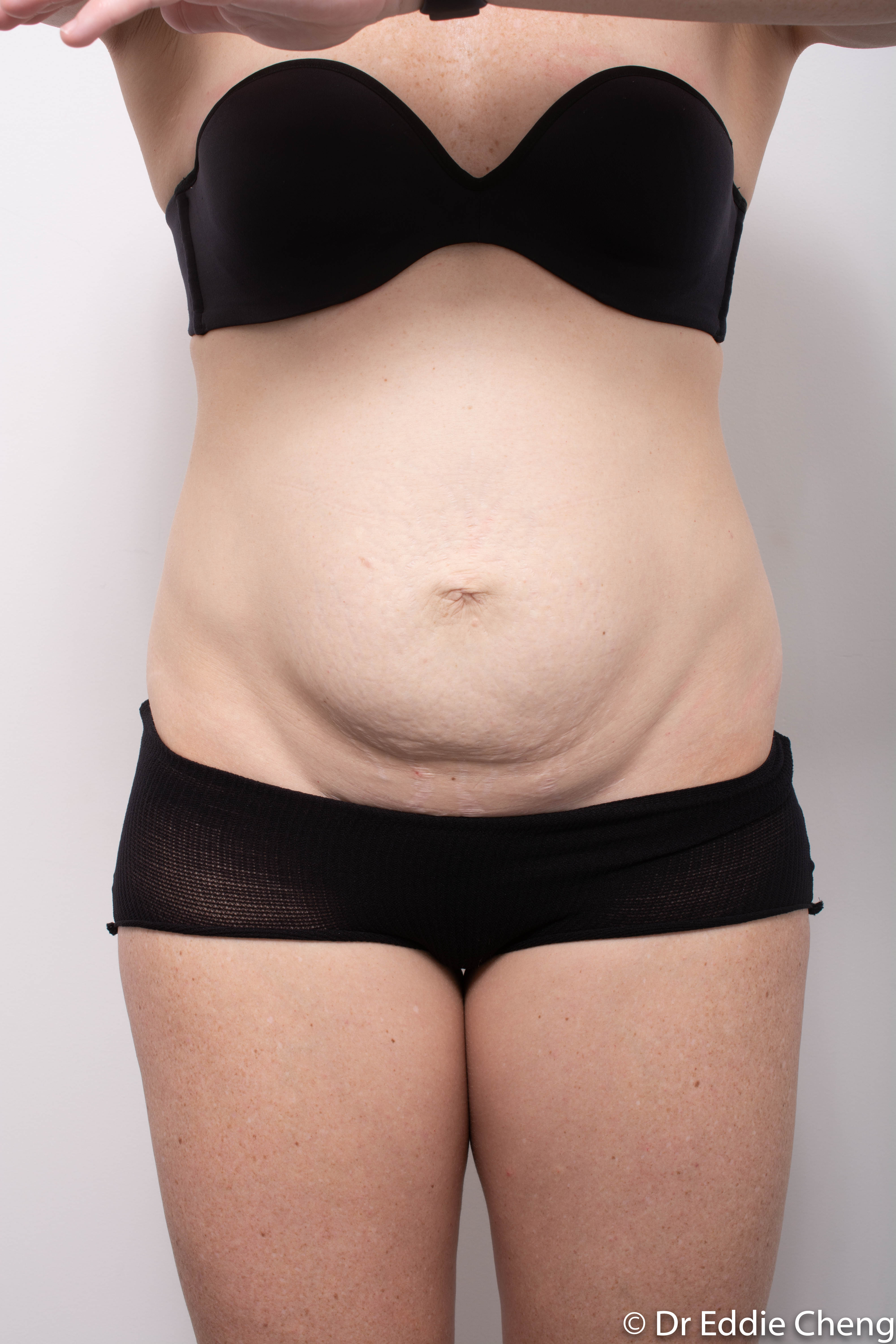 post, abdominoplasty (2 of 4)