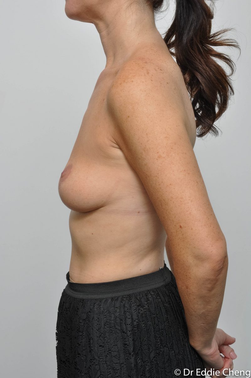 post-op-mastopexy-breast-lift-5-12-3-800x1204-1