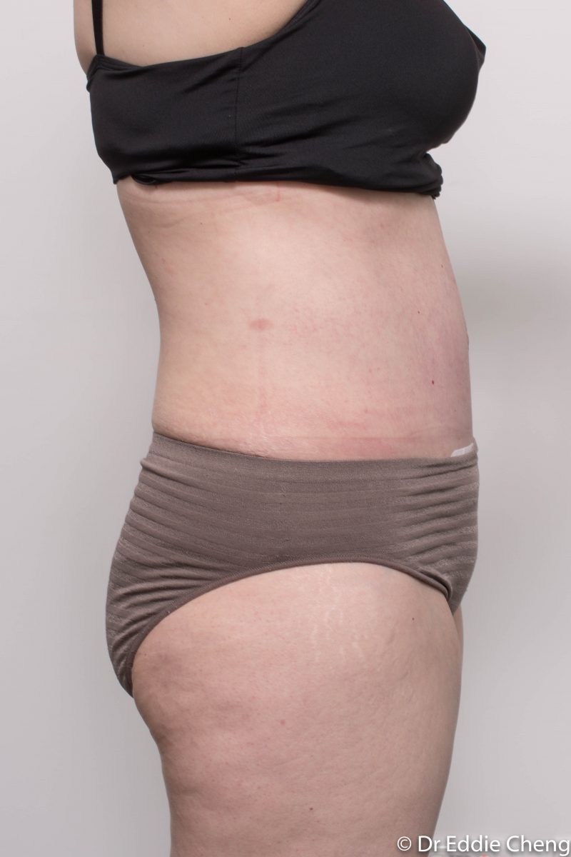 post-op-tummy-tuck-6-weeks-6-5-1-800x1200