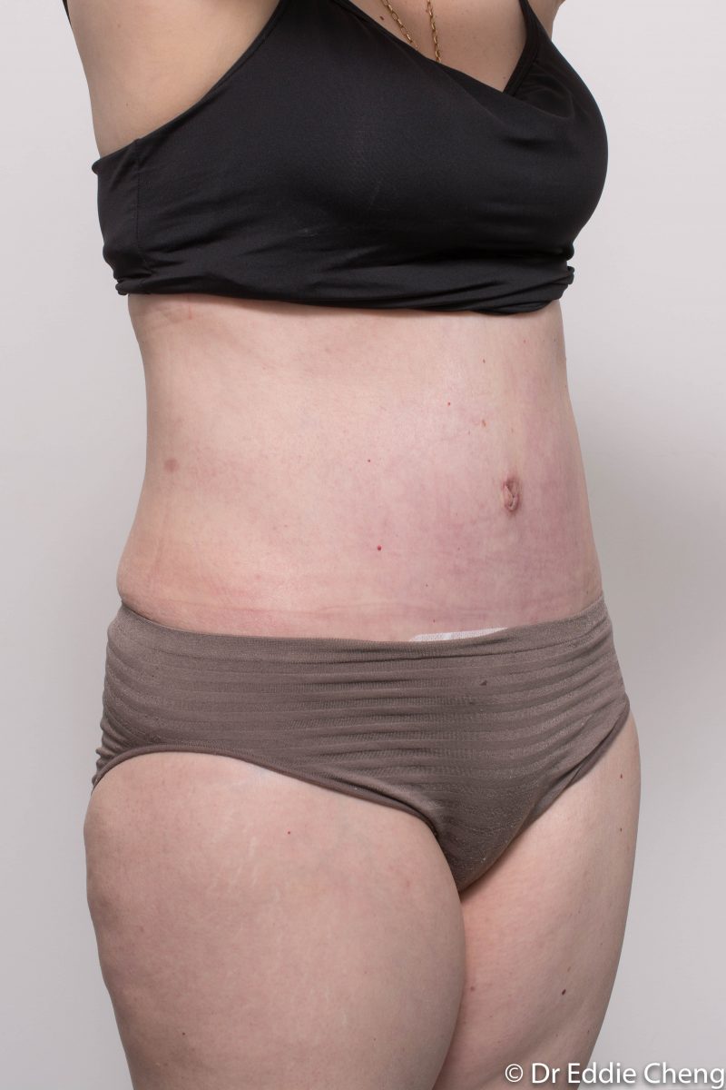 post-op-tummy-tuck-6-weeks-6-5-2-800x1200