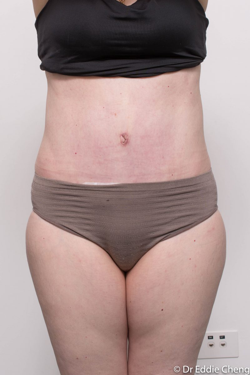 Abdominoplasty