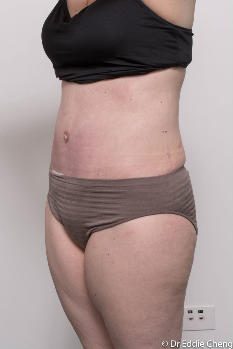 post-op-tummy-tuck-6-weeks-6-5-4-800x1200