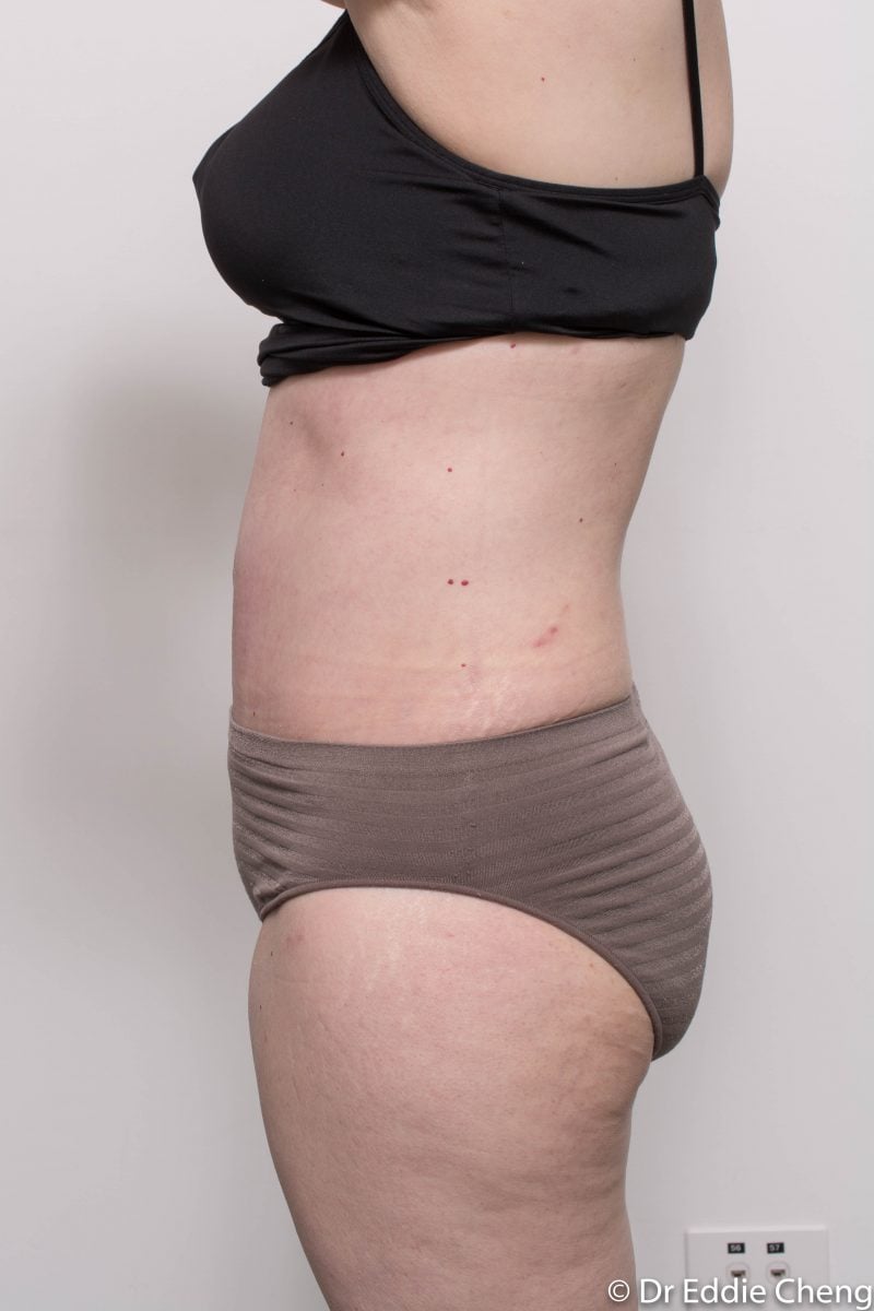 post-op-tummy-tuck-6-weeks-6-5-5-800x1200