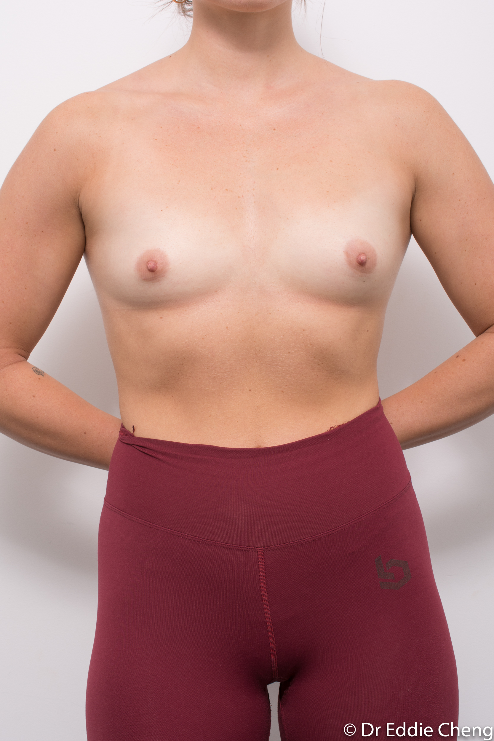 pre op breast augmentation brisbane dr eddie cheng-3