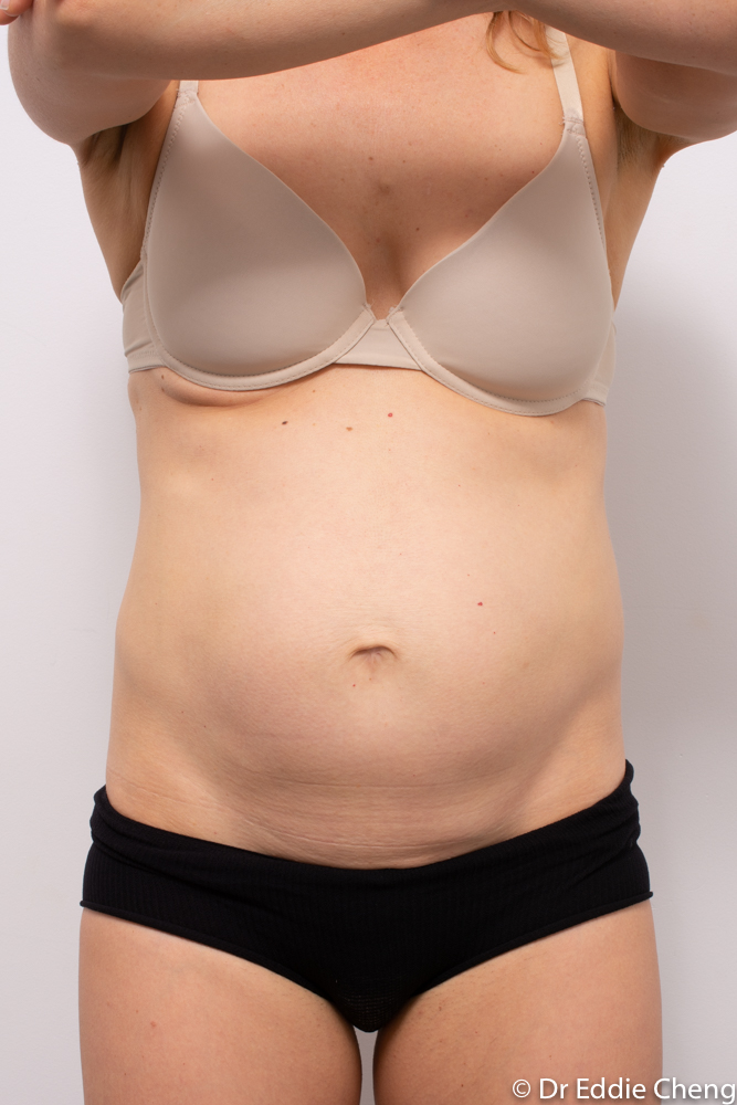 pre op tummy tuck dr eddie cheng brisbane (3 of 5)-1