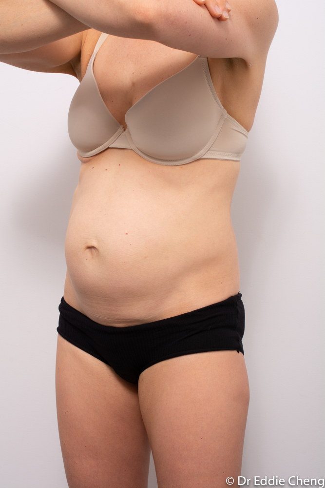 pre op tummy tuck dr eddie cheng brisbane (4 of 5)-1