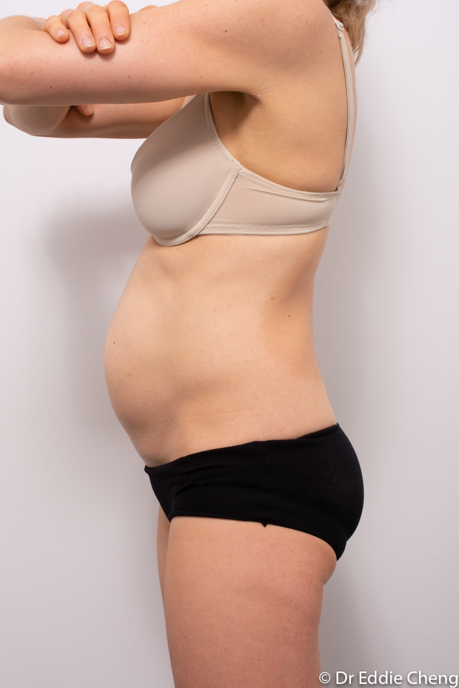 pre op tummy tuck dr eddie cheng brisbane (5 of 5)-1