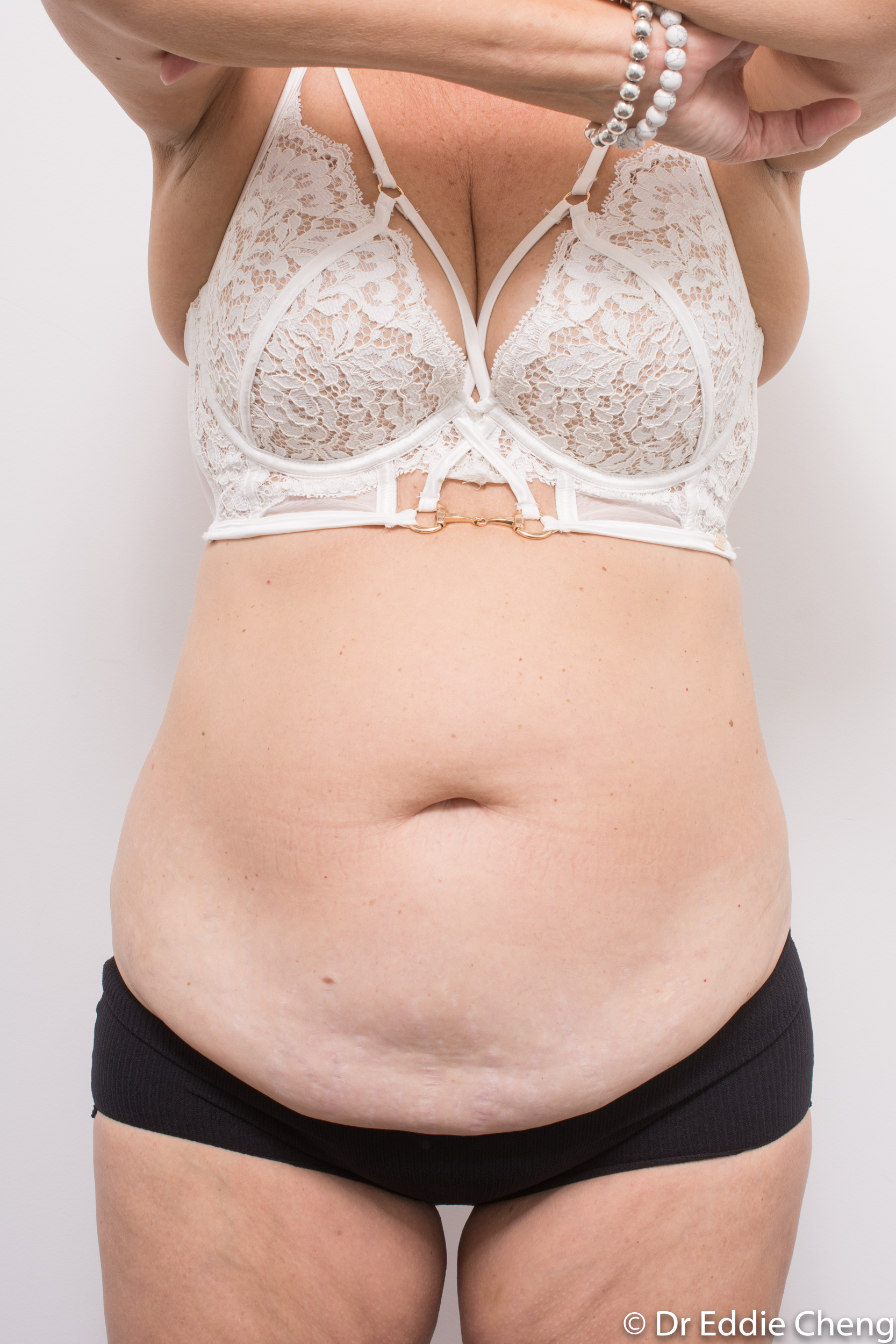 pre tummy tuck dr eddie cheng brisbane-3