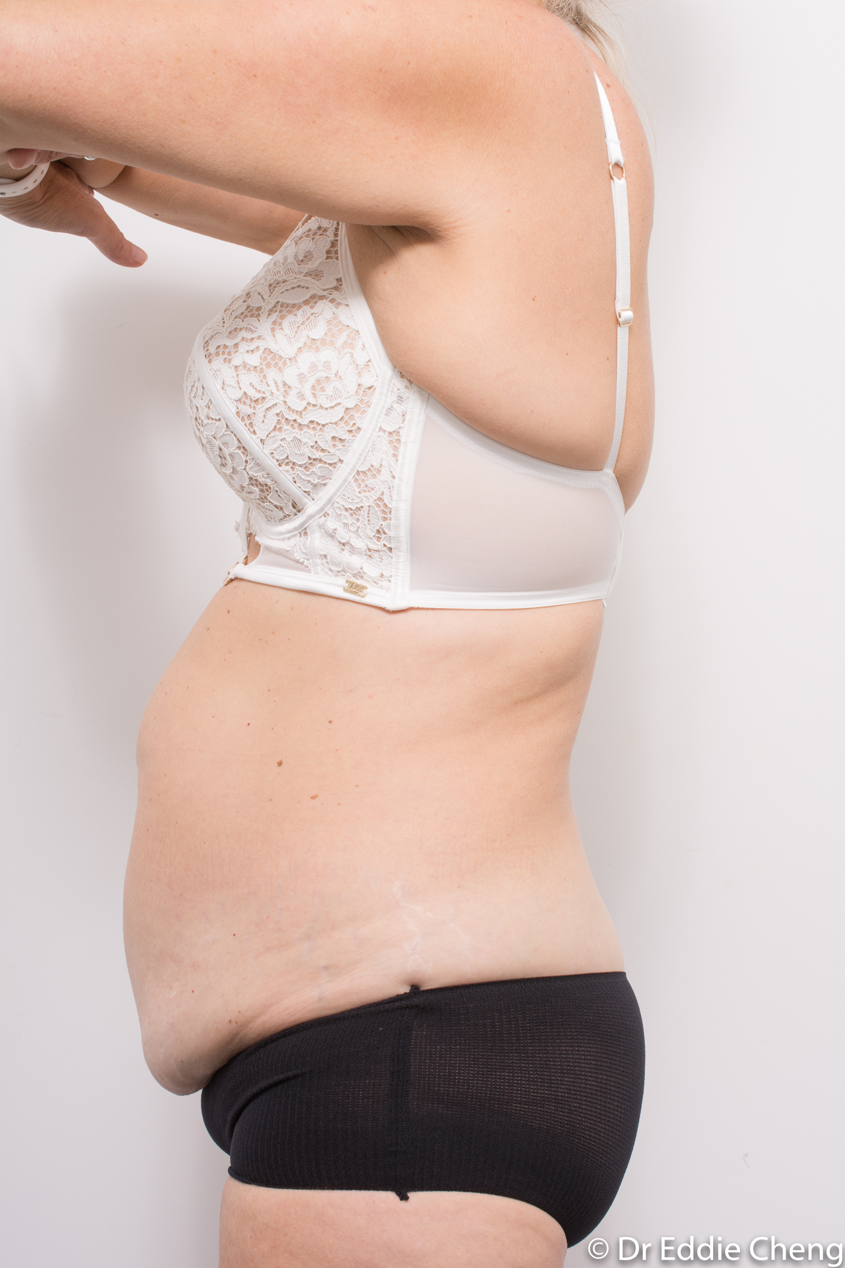 pre tummy tuck dr eddie cheng brisbane-5