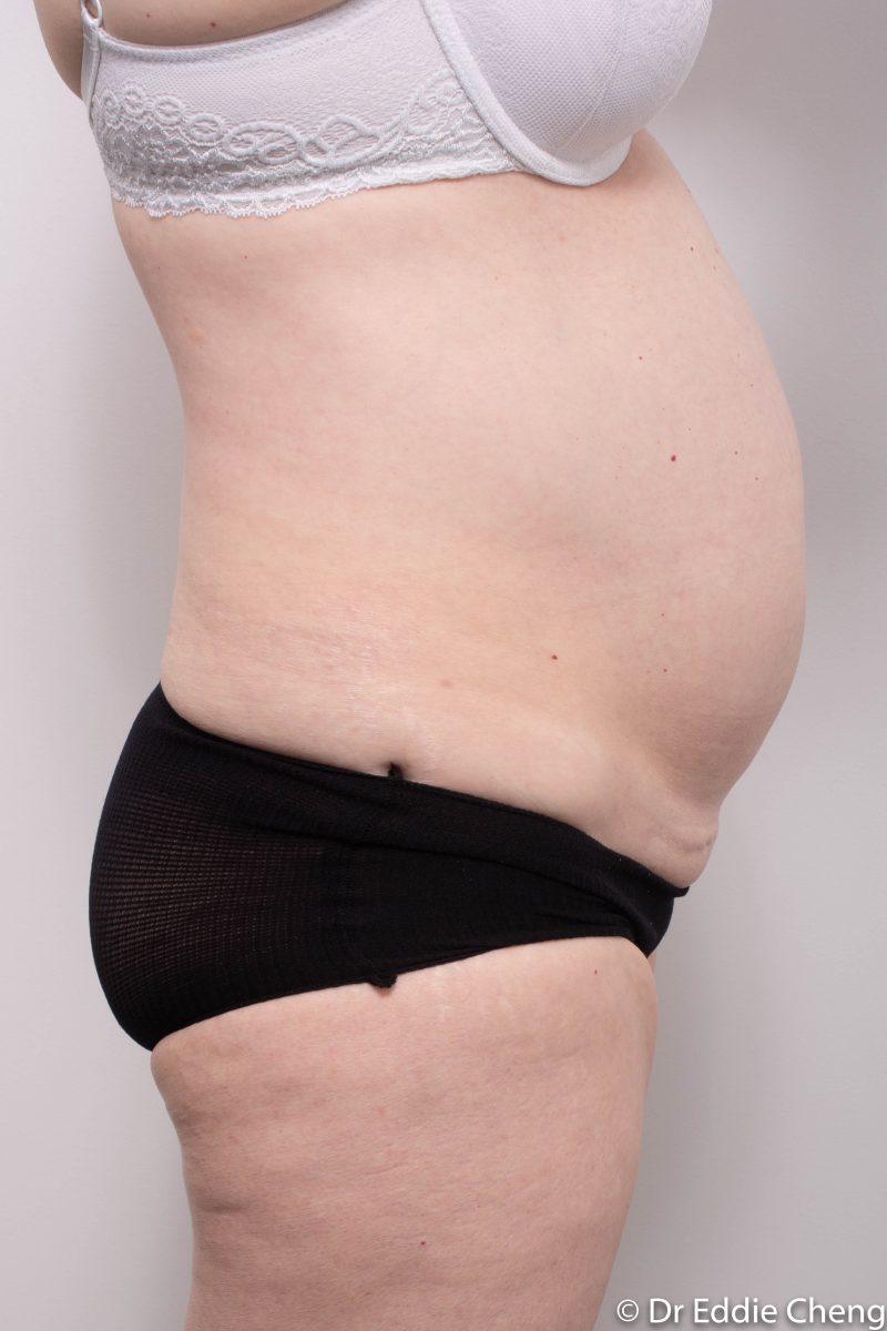 pre-op-tummy-tuck-1-800x1200