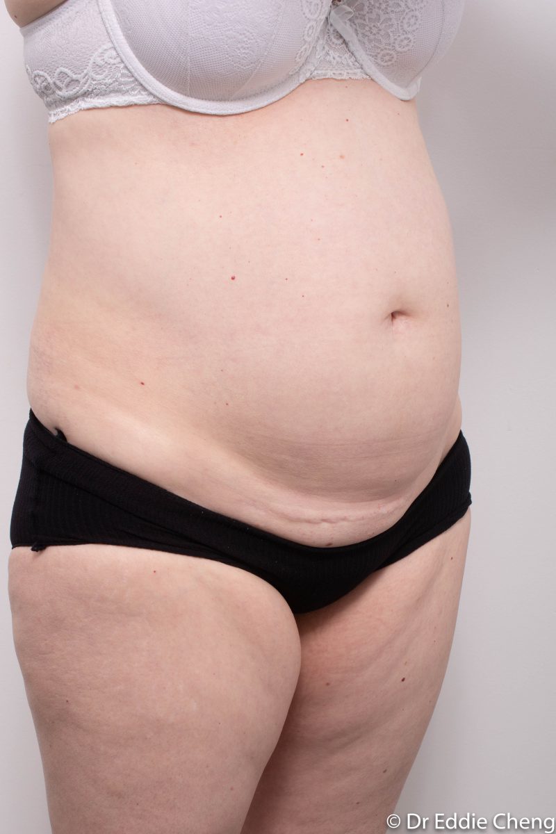 pre-op-tummy-tuck-2-800x1200