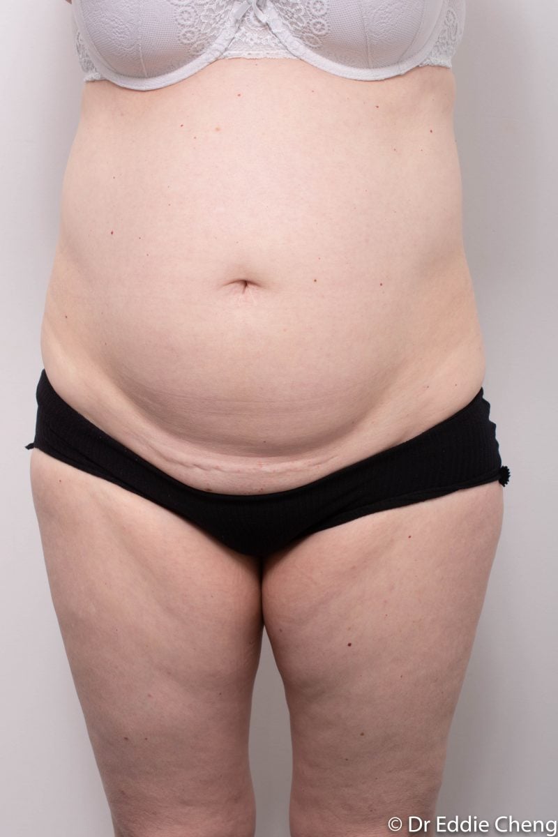 Abdominoplasty