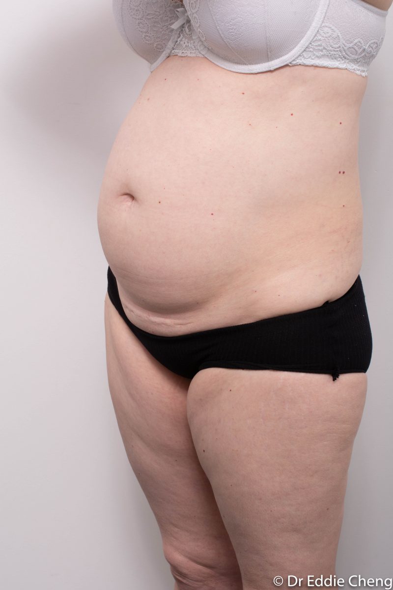 pre-op-tummy-tuck-4-800x1200