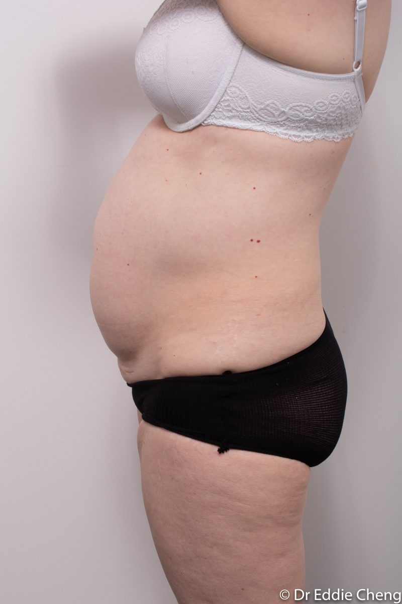 pre-op-tummy-tuck-5-800x1200