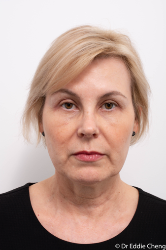 upper blepharoplasty dr eddie cheng brisbane