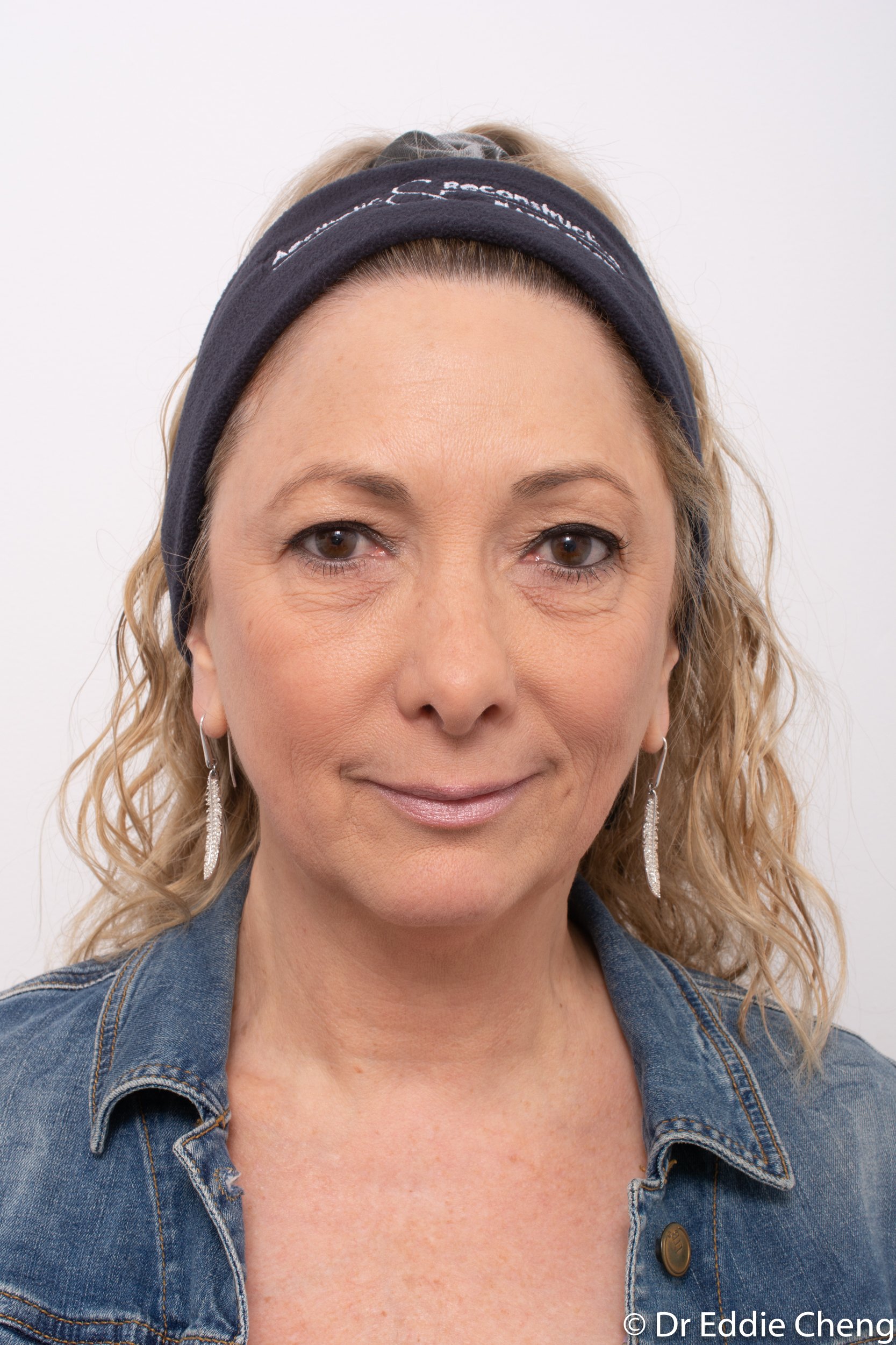 upper blepharoplasty browlift dr eddie cheng brisbane-1